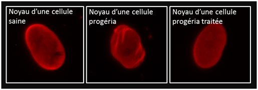 Schema progeria