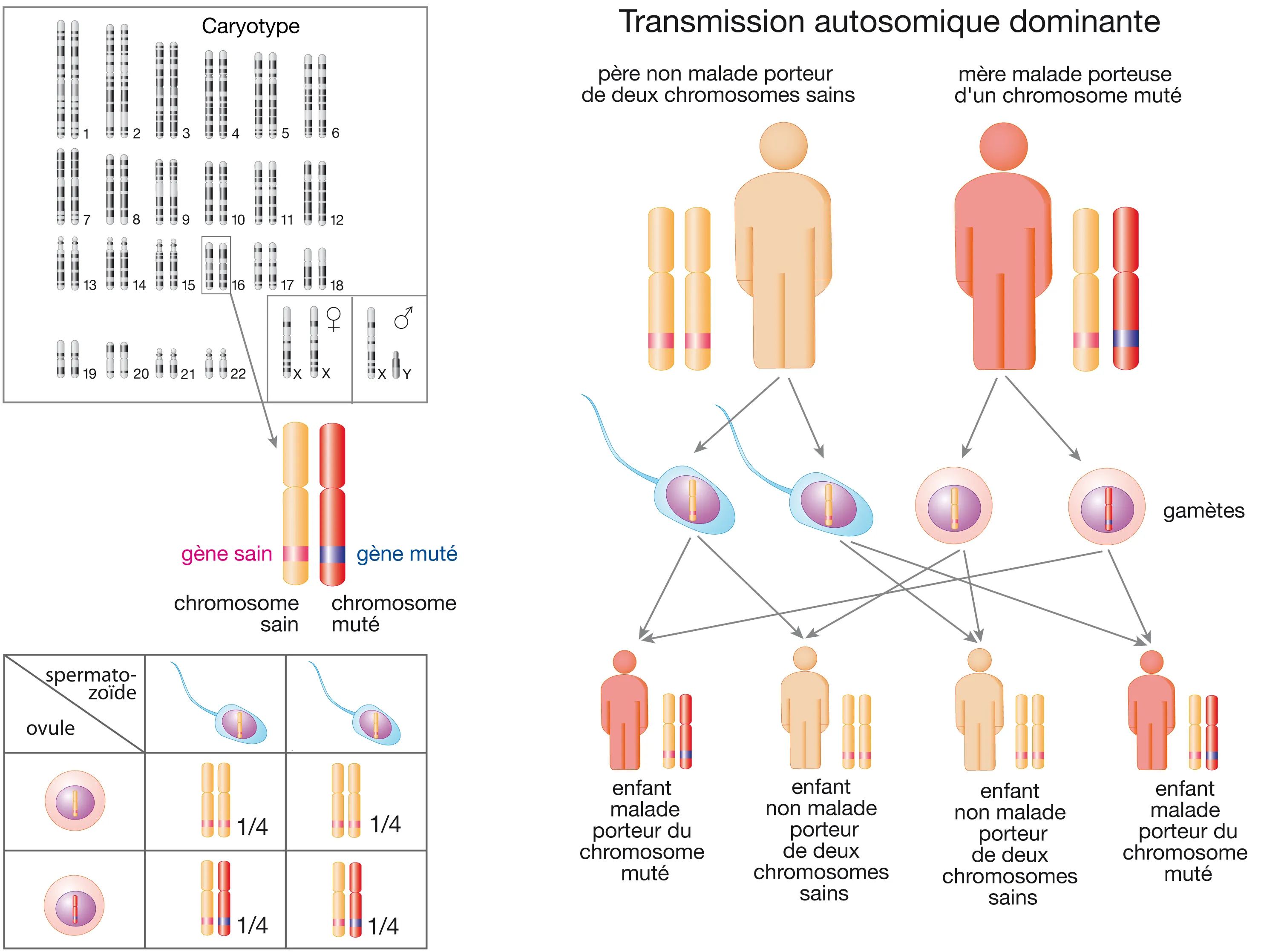 Description de la transmission d'une anomalie présente dans un gène situé sur un des autosomes (chromosomes non sexuels) dans le cas d'une transmission dite dominante