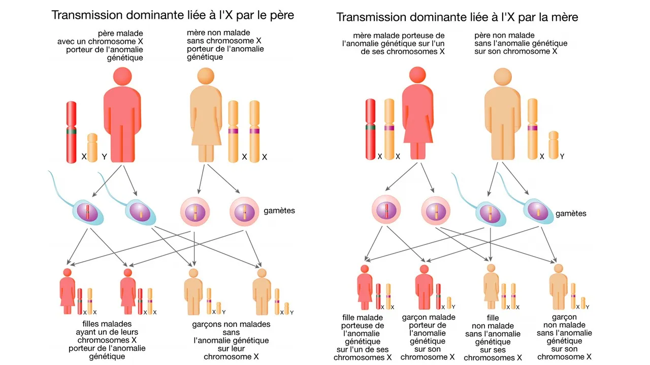 Description de la transmission d'une anomalie présente dans un gène situé sur le chromosome X, dans le cas d'une transmission dominante, par le père ou par la mère